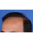 After Hair Transplant&nbsp;Front